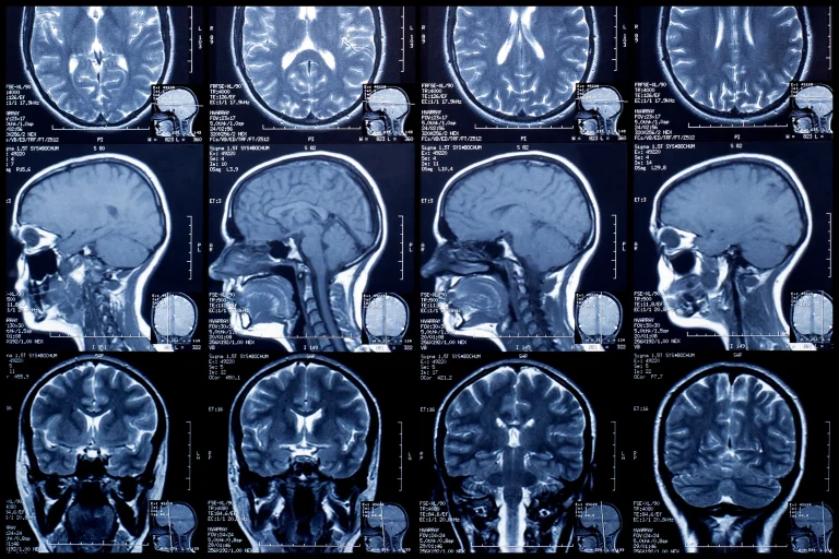 MRI Scans