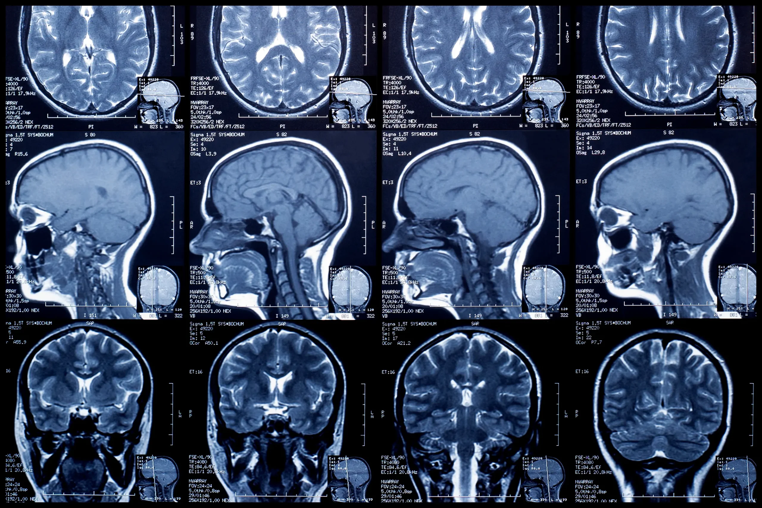 MRI Scans