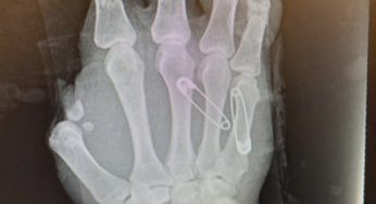 The Worst Accident in Radiology History