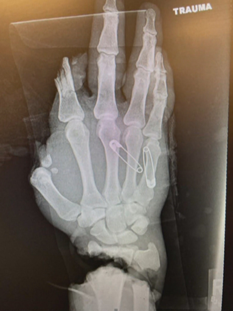 The Worst Accident in Radiology History